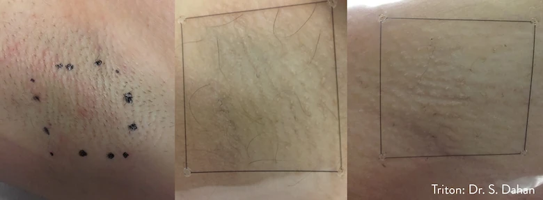 avant après laser sous les aisselles - image 3 of 6