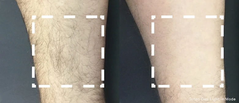 avant et après traitement d'épilation laser jambes - image 4 of 6